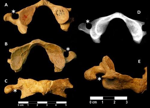 Atlas neandertal recuperado en Kraprina/Carlos A. Palancar et al. 