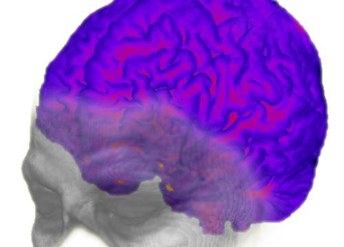 Alzheimer&#039;s Disease: The Downside of a Highly Evolved Parietal Lobe?