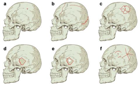 Fracture types based on their morphology identified in the study/ Daniel Rodríguez Iglesias 