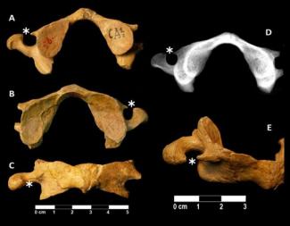 Atlas neandertal recuperado en Kraprina/Carlos A. Palancar et al. 