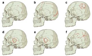 Fracture types based on their morphology identified in the study/ Daniel Rodríguez Iglesias 