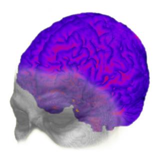 Alzheimer&#039;s Disease: The Downside of a Highly Evolved Parietal Lobe?