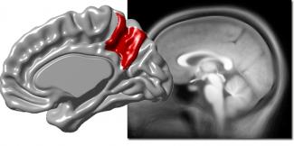 Cortical surface area and cortical thickness in the precuneus of adult humans