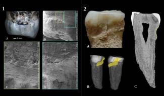 Premolar Yiyuan/IVPP y premolar Sima del Elefante/CENIEH Un estudio evidencia que Homo erectus pudo usar palillos para su higiene bucal